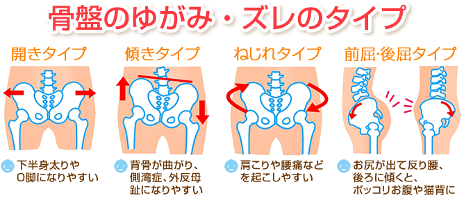 骨盤のタイプのイラスト