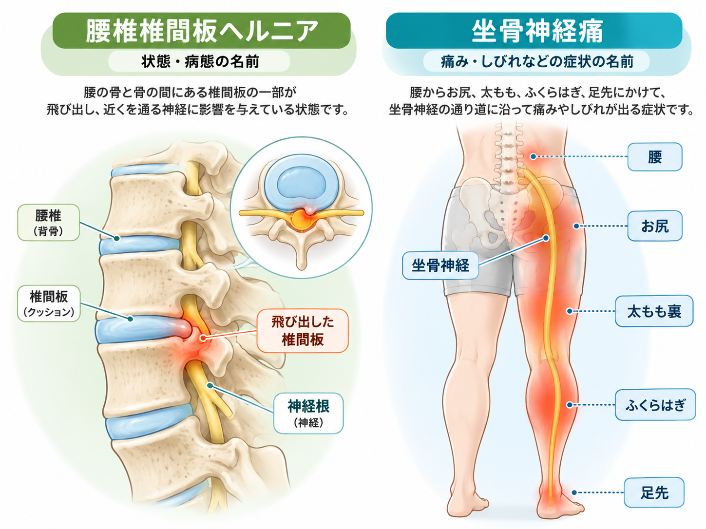 腰椎椎間板ヘルニアと坐骨神経痛の違いを示した腰と脚の解剖イラスト